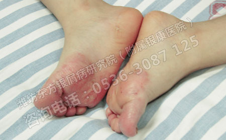 春季银屑病该如何护理才能避免复发呢？