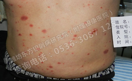 春季里如何预防银屑病复发呢