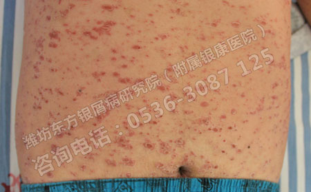 潍坊银屑病医院告诉你如何治疗银屑病才有效