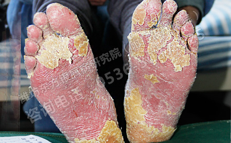 现在治疗银屑病有什么可以得方法吗