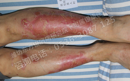 到了夏天银屑病可以不治疗自己好的吗