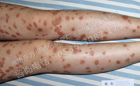 夏季银屑病复发该怎么进行治疗