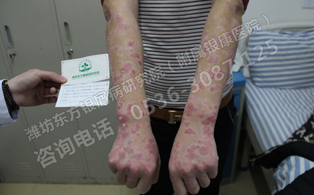 银屑病患者的夏季护理尤其注意这几点