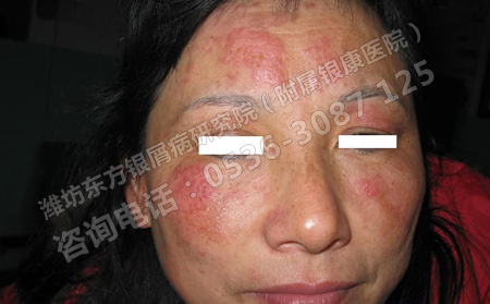 潍坊牛皮癣医院是如何治疗牛皮癣的