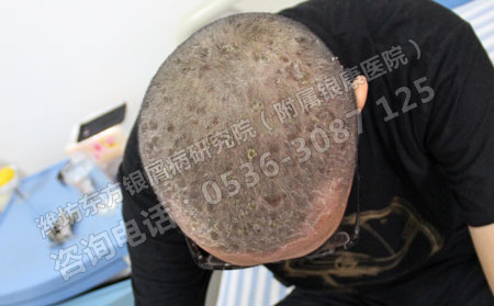 头部牛皮癣如何治疗呢