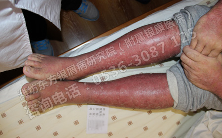 怎样做好银屑病的护理工作呢