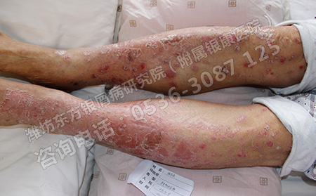 牛皮癣夏季护理需要注意的小问题