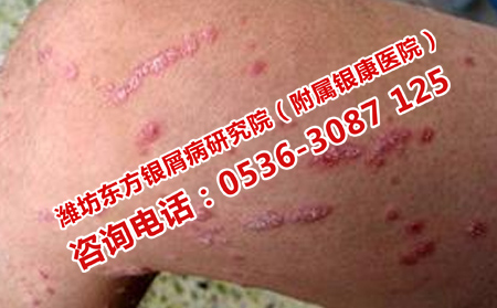 五月如何做好银屑病的护理