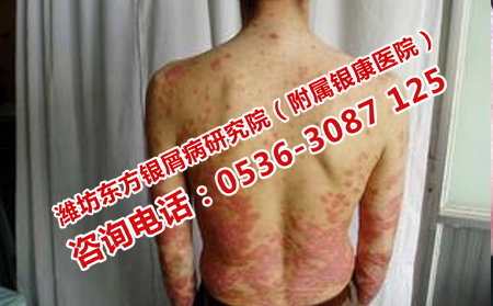 银屑病治疗禁忌你了解吗