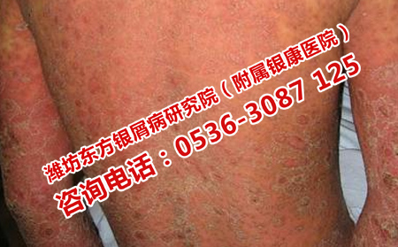 潍坊治疗牛皮癣有效的医院