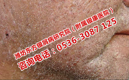 银屑病为什么要及时治疗