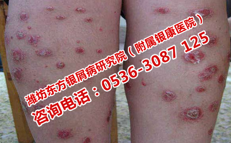 刚得的牛皮癣怎么治疗好