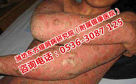 怎样使牛皮癣夏季不发作
