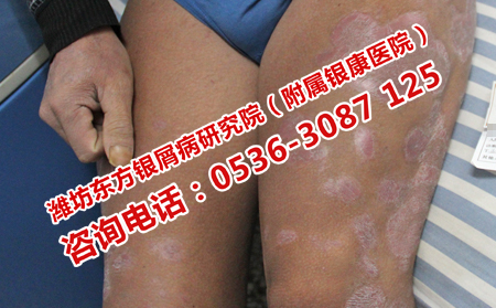 多年牛皮癣有什么治疗技巧