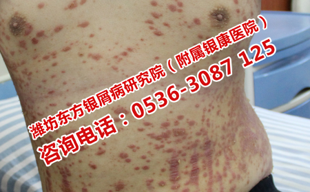 急性寻常型牛皮癣治疗