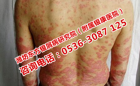 牛皮癣患者如何度过秋天