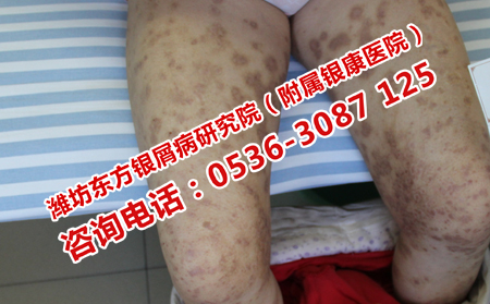 寒冷时期的银屑病预防办法