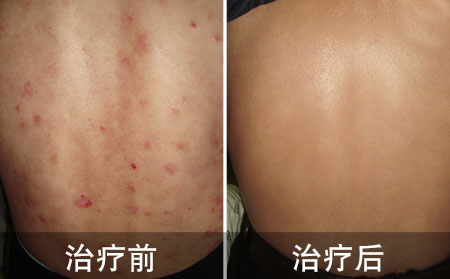 选对医院好的背部银屑病