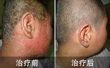 乱用其他方加重银屑病的案例