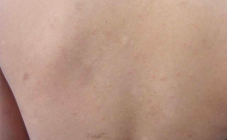 背部的银屑病恢复症状