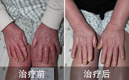 盲目忌口导致银屑病加重
