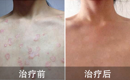 好的女孩胸部银屑病的案例