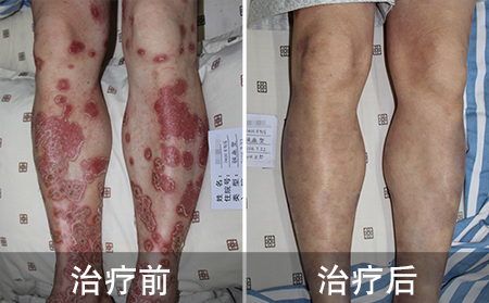 钱先生艰难的治疗牛皮癣历程