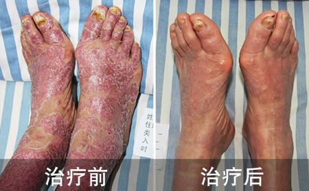 银屑病患者艰难的恢复之路