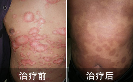 钱币状银屑病好的案例