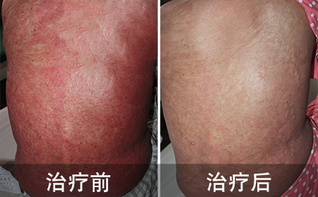 背部红皮型银屑病案例