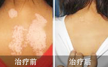 白癜风恢复案例