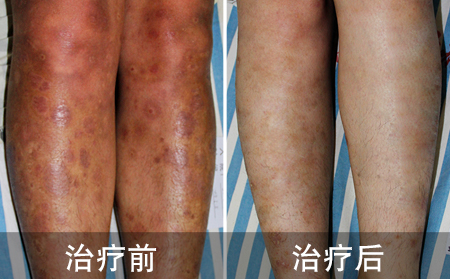 腿部银屑病好的案例