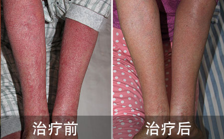 银屑病治疗案例
