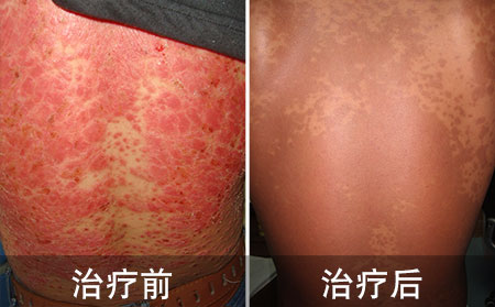 背部银屑病好的病例