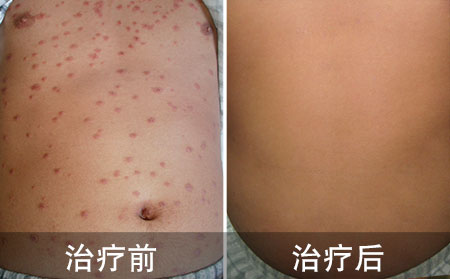 急性点滴性银屑病治疗