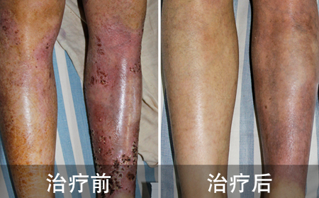 腿部顽固银屑病病例