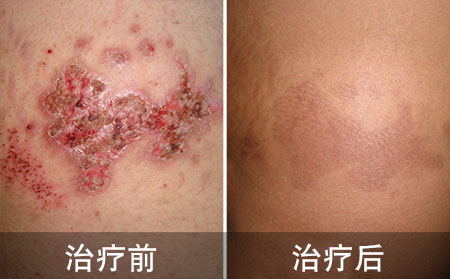 银屑病瘙痒治疗