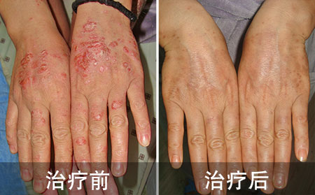手部银屑病恢复案例