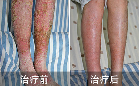 初期腿部银屑病案例