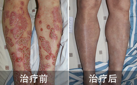 多年腿部银屑病案例