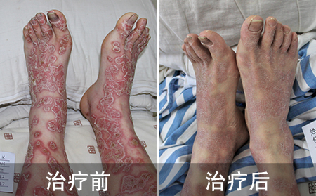 脚部银屑病的恢复案例