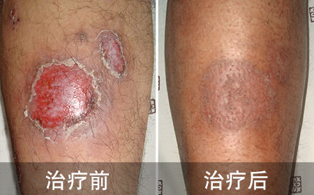 腿部银屑病案例