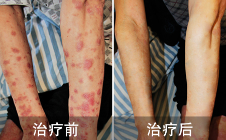 男性胳膊银屑病案例