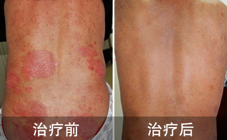 背部银屑病案例