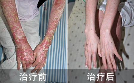 小伙子好的全身银屑病
