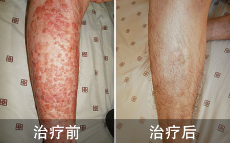 单亲妈妈好的银屑病
