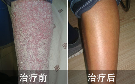 好的严重牛皮癣的病情