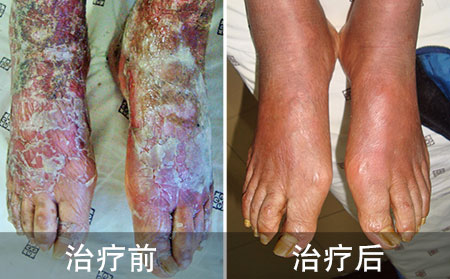 脚部脓疱性银屑病案例