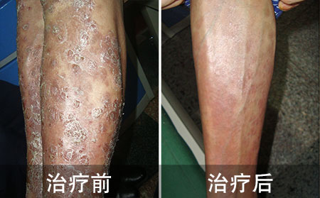 腿部银屑病好的案例