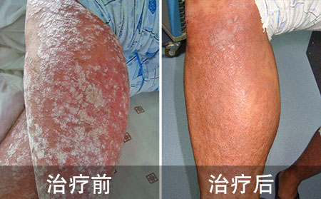 学生好的脓疱性银屑病